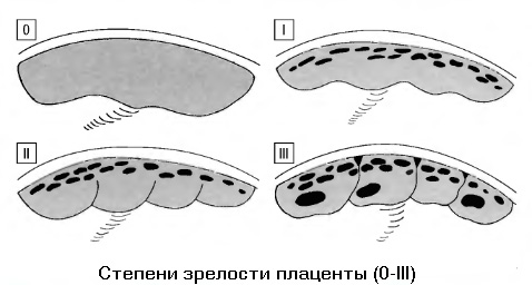 Степени старения плаценты