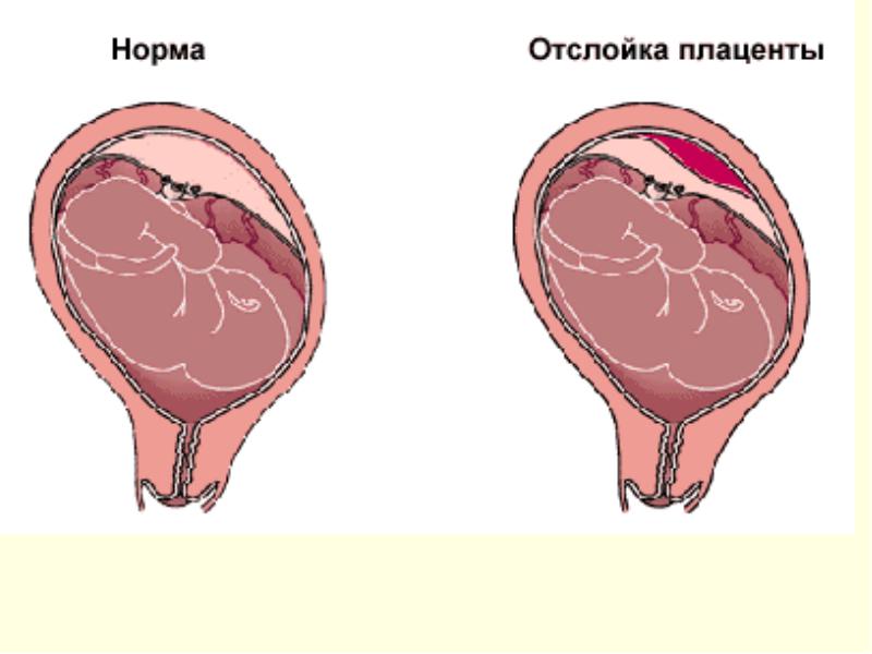 Отслойка плаценты и норма