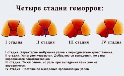 Четыре стадии геморроя