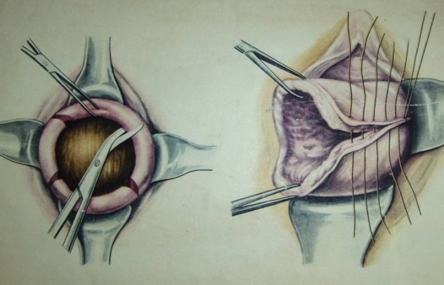 ушивание разрыва шейки матки