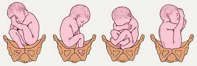 Как плод располагается в матке