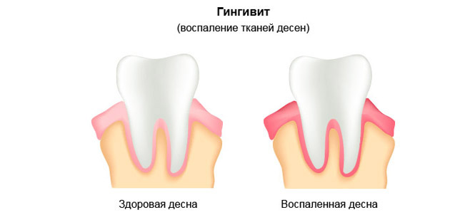 Как проявляется гингивит