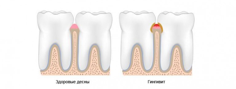 Признаки гингивита у ребенка