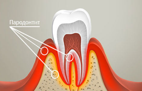 Как выглядит пародонтит