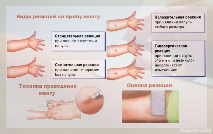 Реакции на пробу Манту