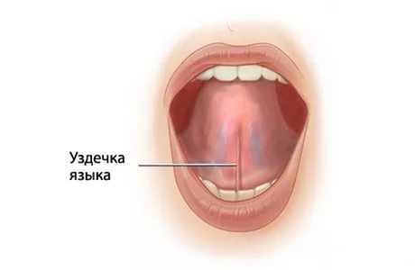 Причины появления короткой уздечки языка