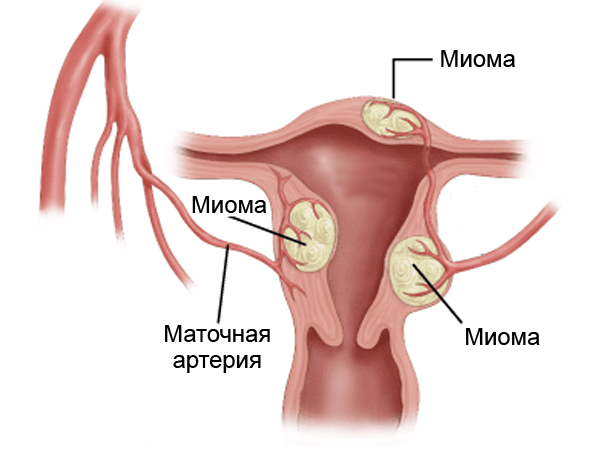 Как выглядит миома в матке