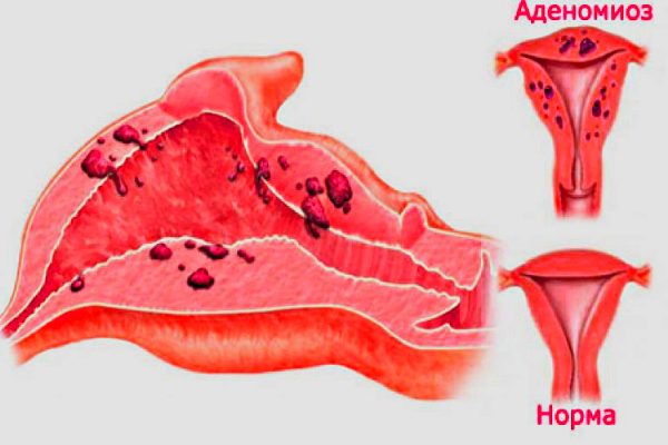 аденомиоз