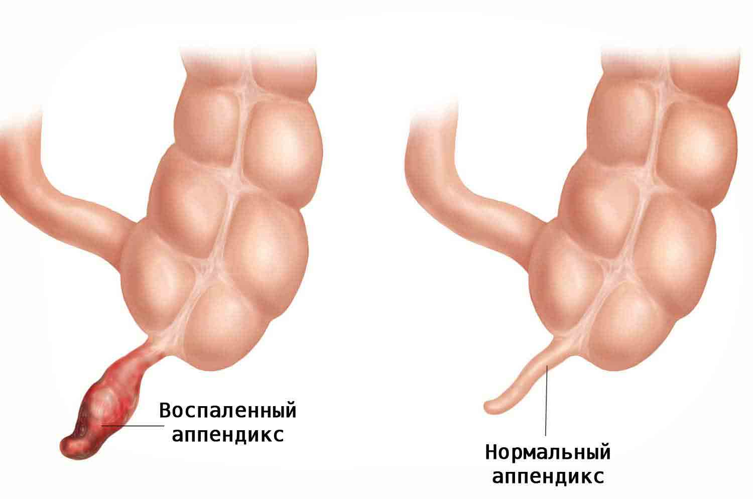 аппендицит