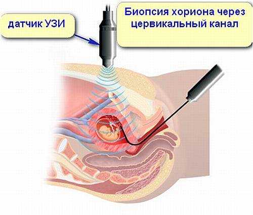 биопсия хориона