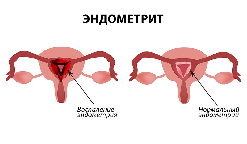 эндометрит