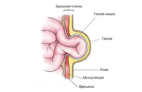 грыжа у младенца