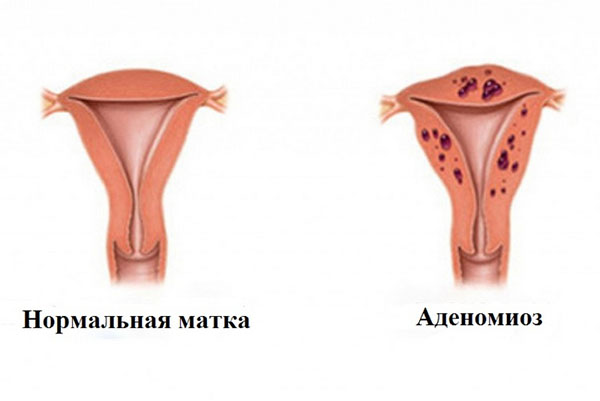 как выглядит аденомиоз