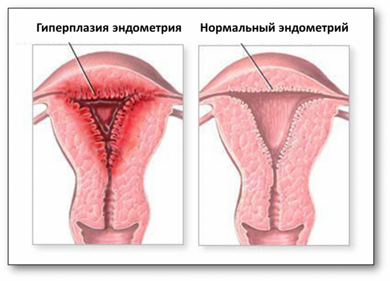 как выглядит гиперплазия