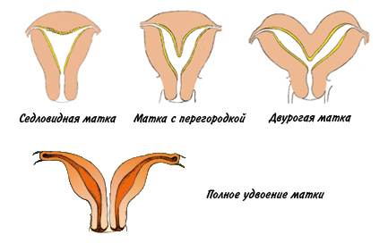 как выглядит седловидная матка