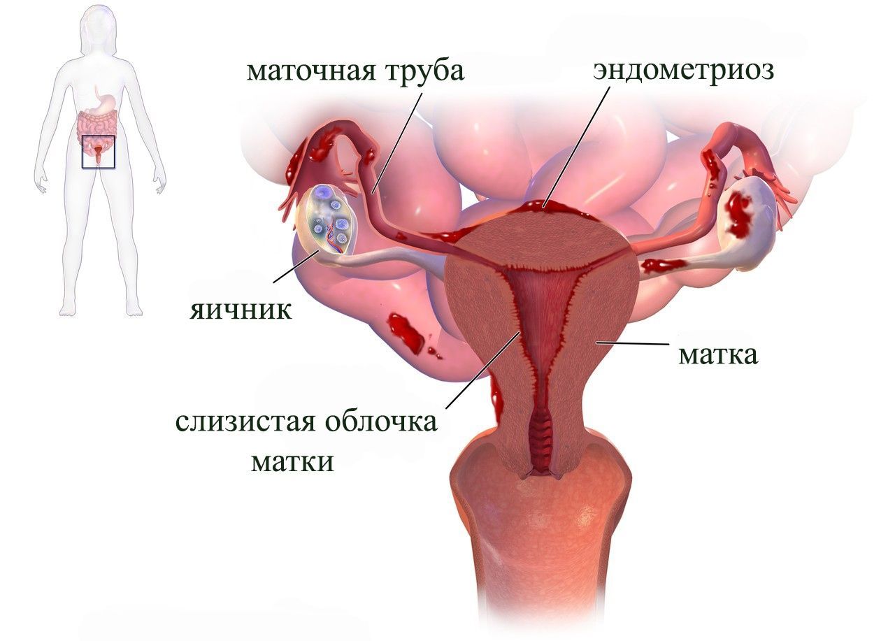 картина эндометриоза