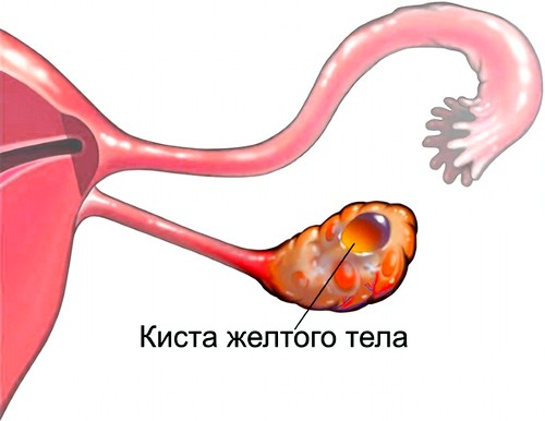 киста желтого тела