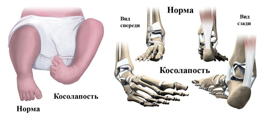 косолапость у новорожденных