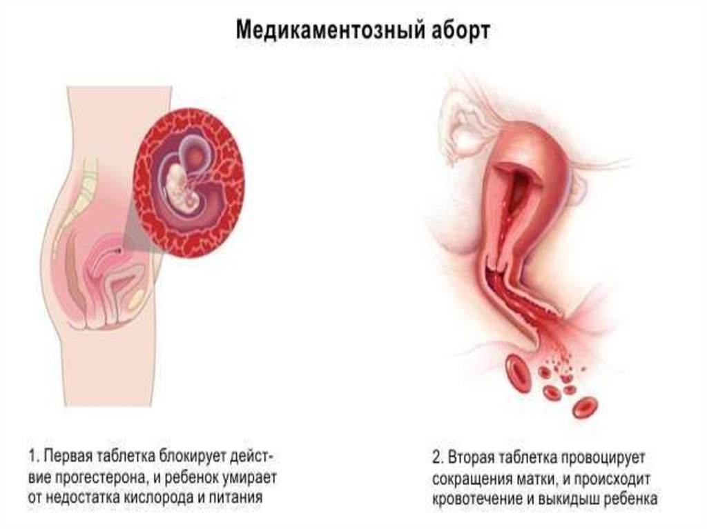 медикаментозный аборт