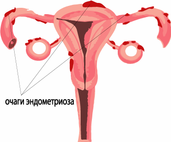 очаги эндометриоза