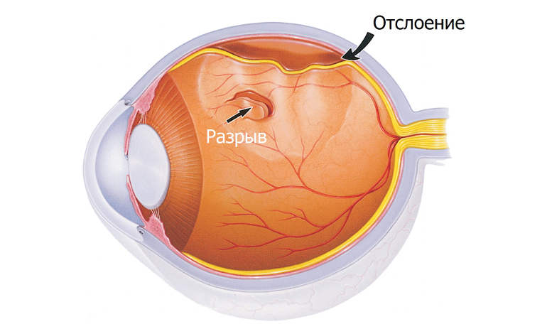 отслоение сетчатки