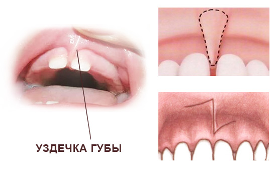 пластика на верхней губе