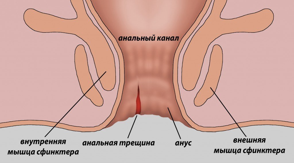 причины анальной трещины