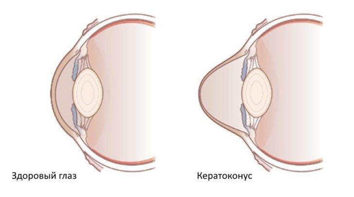 роговица при кератоконусе