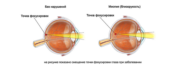 смещение фокусировки при миопии