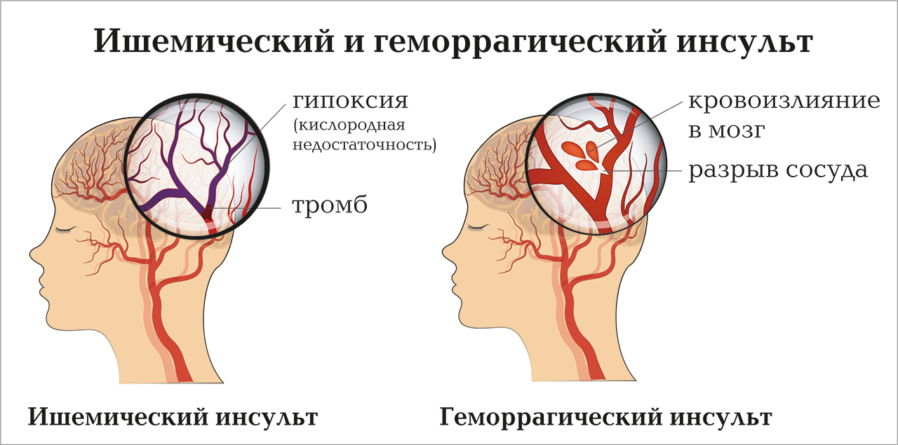 виды инсульта