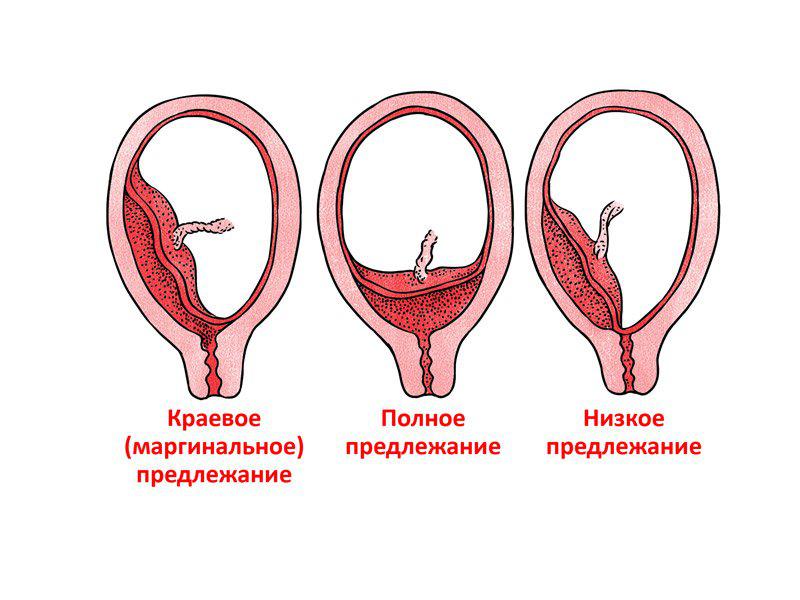 виды предлежаний