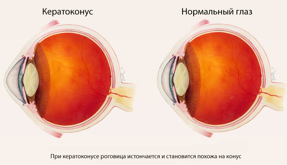 внешний вид кератоконуса