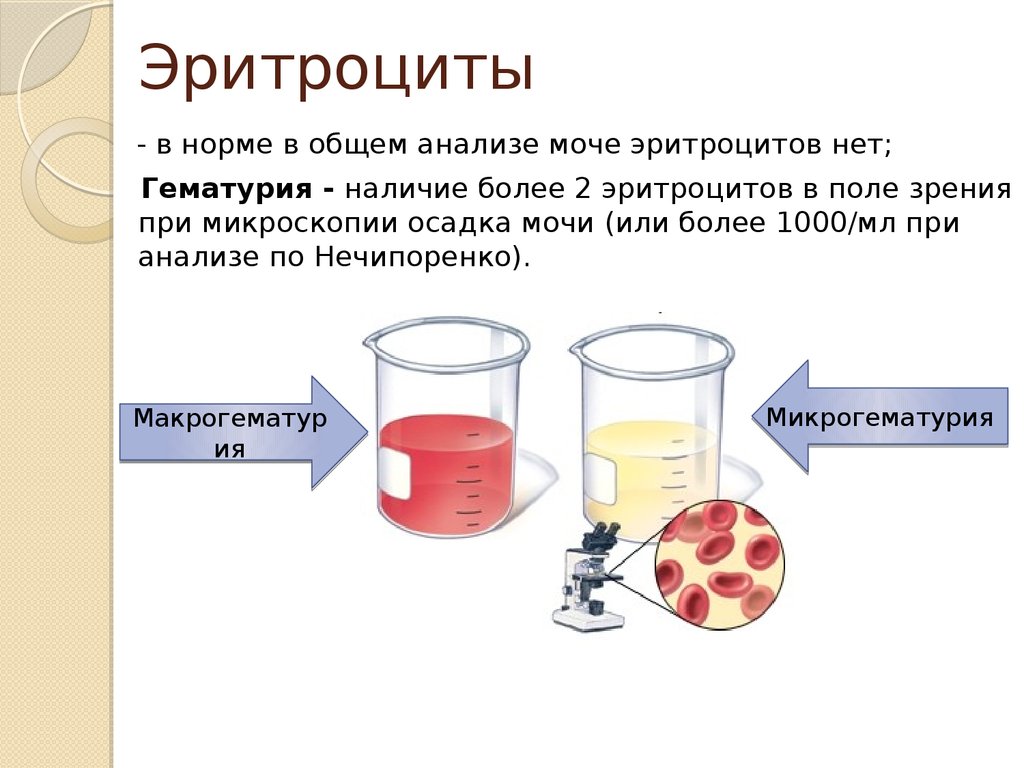 высокие эритроциты в анализе мочи